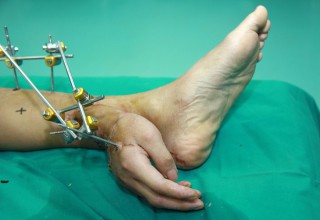 В Китае врачи пришили отрезанную руку к ноге пациента