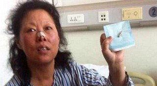 Китаянка прожила 48 лет с пулей в голове