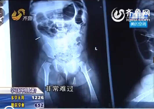В Китае в теле годовалой девочки были найдены 16 иголок