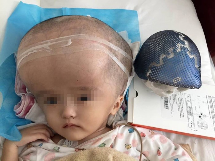 В Китае прооперировали девочку с водянкой мозга