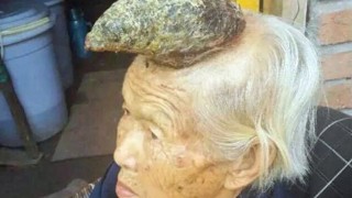 у китаянки вырос рог